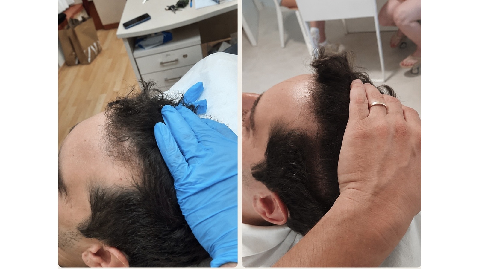 לפני ואחרי — אזור קדמי וקודקוד — גבר